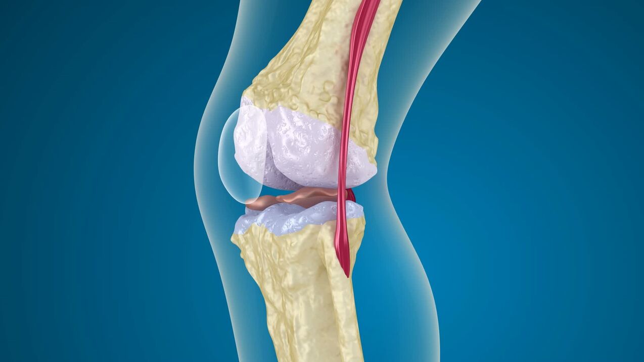 разрушение коленного сустава при артрозе